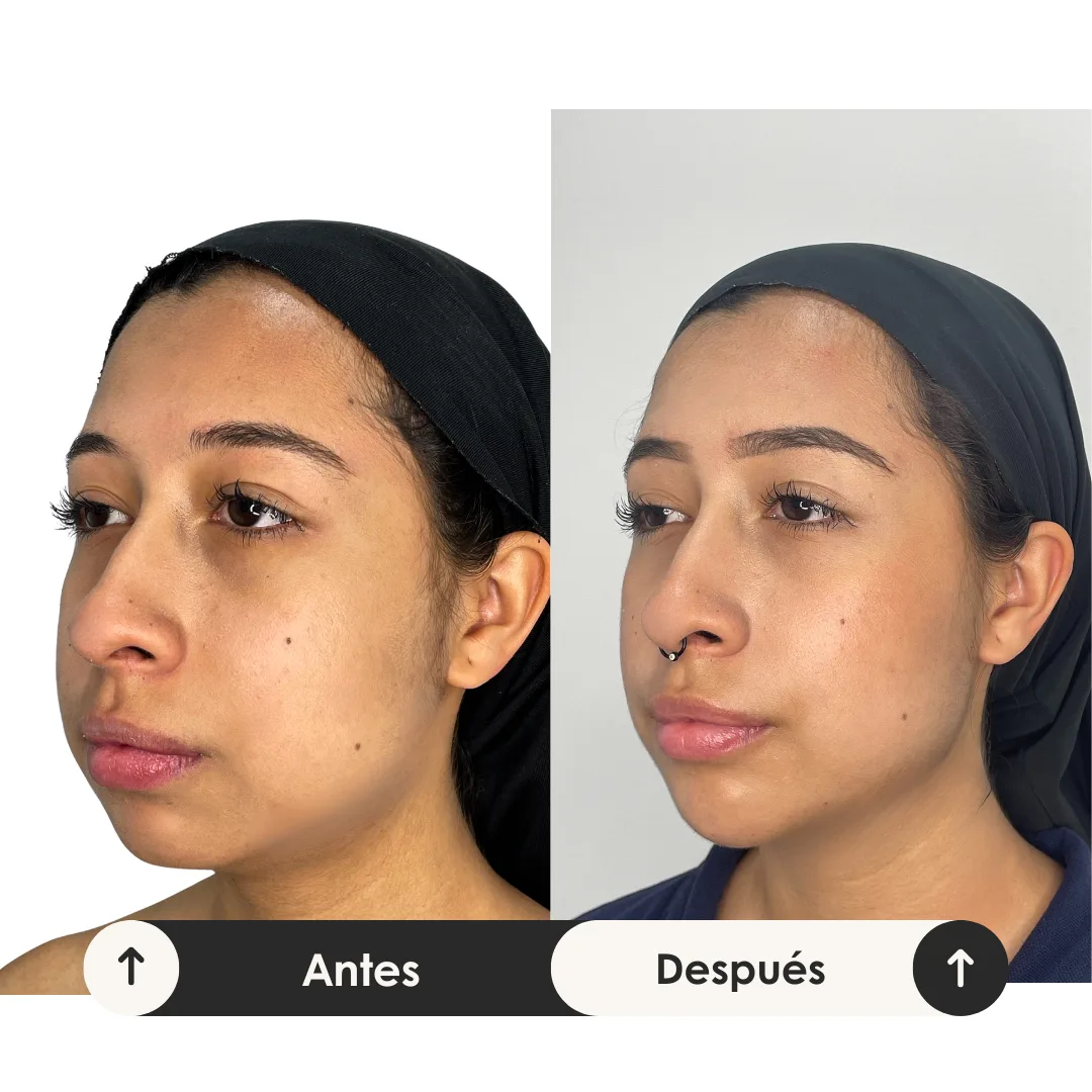 Antes y despues acido hialuronico en menton antes y despues